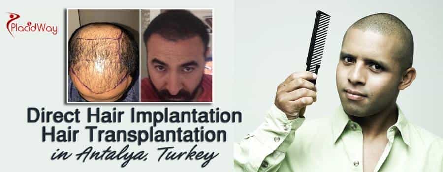 DHI Hair Transplant in Antalya, Turkey